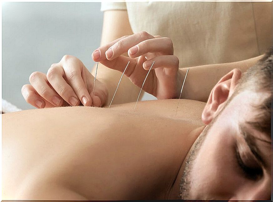 Acupuncture is part of natural therapies.