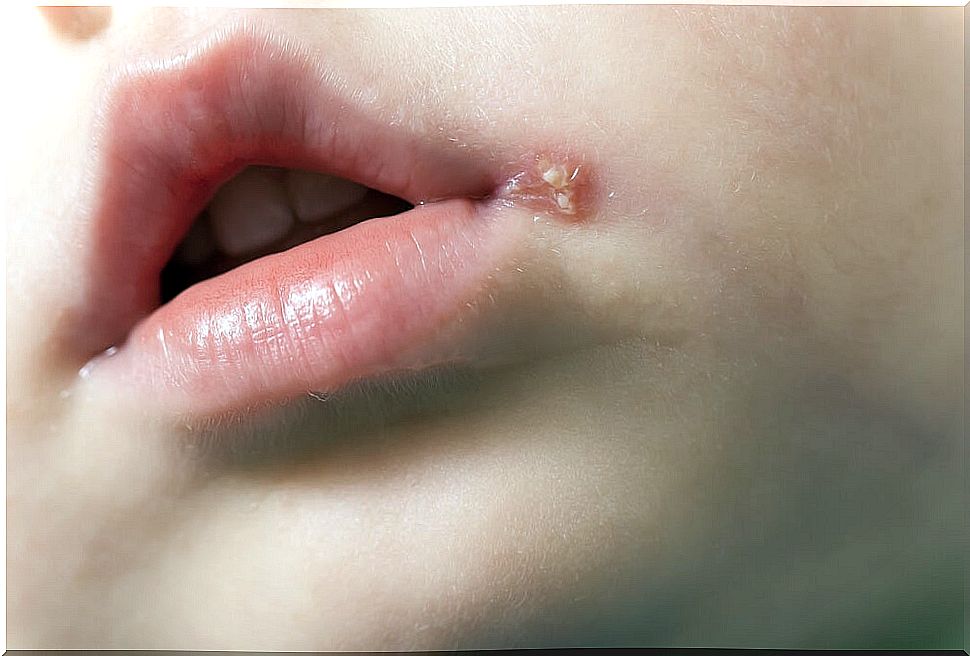 Cold sores in children.