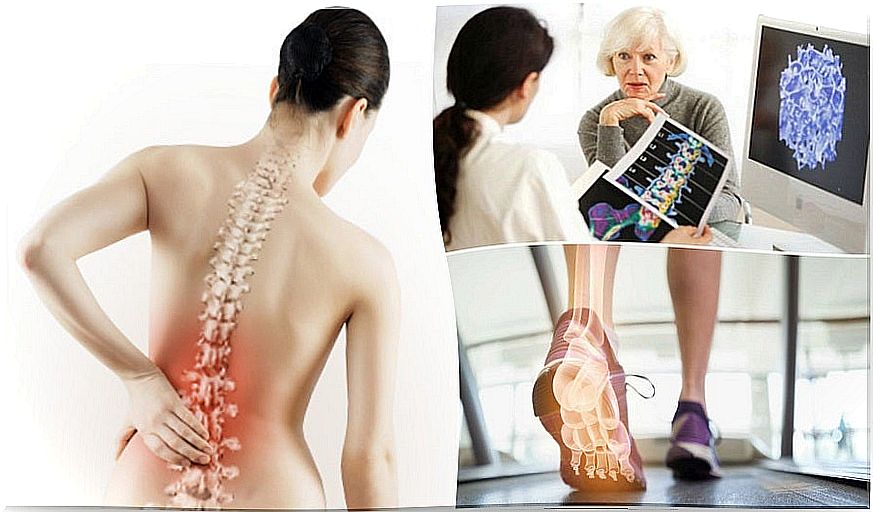 6 things you should know about osteoporosis