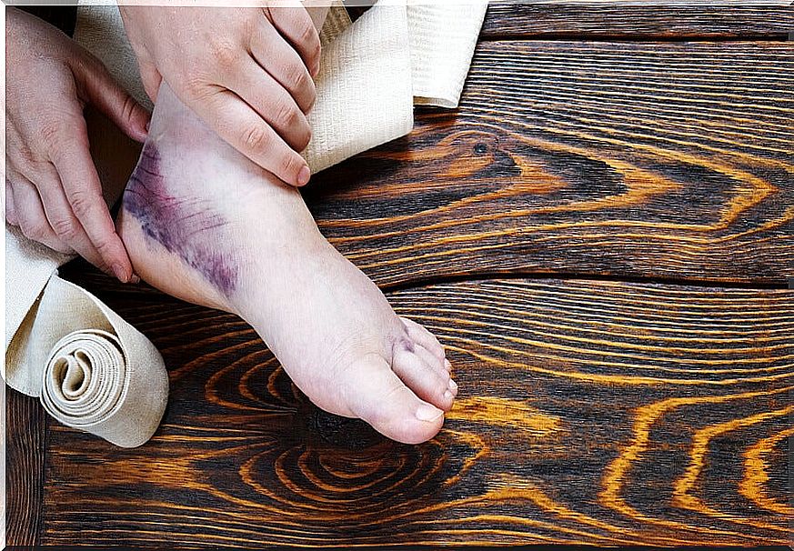 Hematoma and ankle sprain