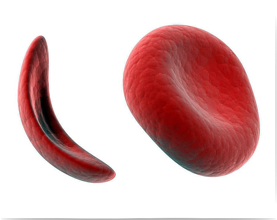 Sickle cell anemia