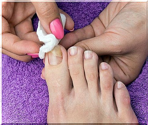 Technique-of-the-cotton-ball-for-ingrown-nails