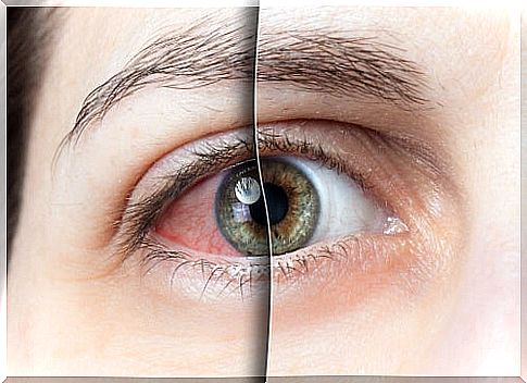 conjunctivitis as a symptom of coronavirus