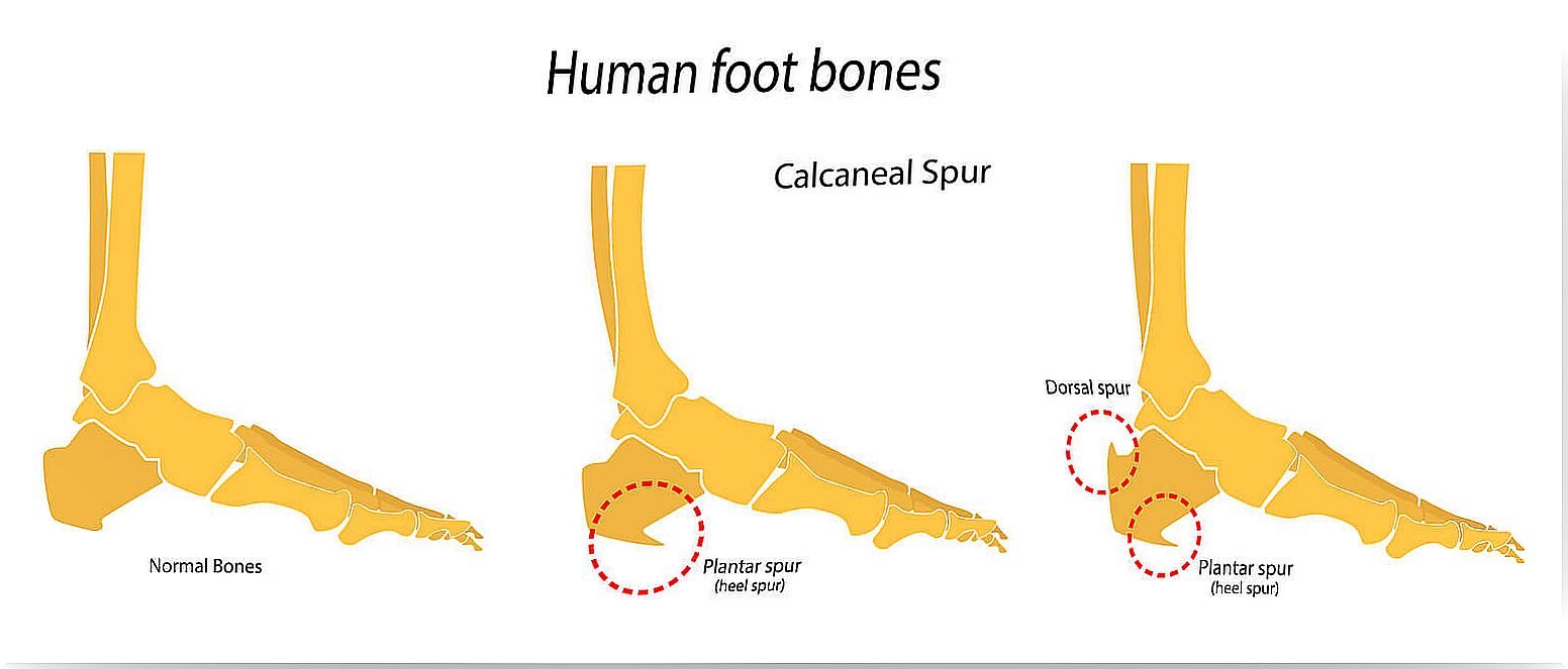 Foot bones: heel spur.