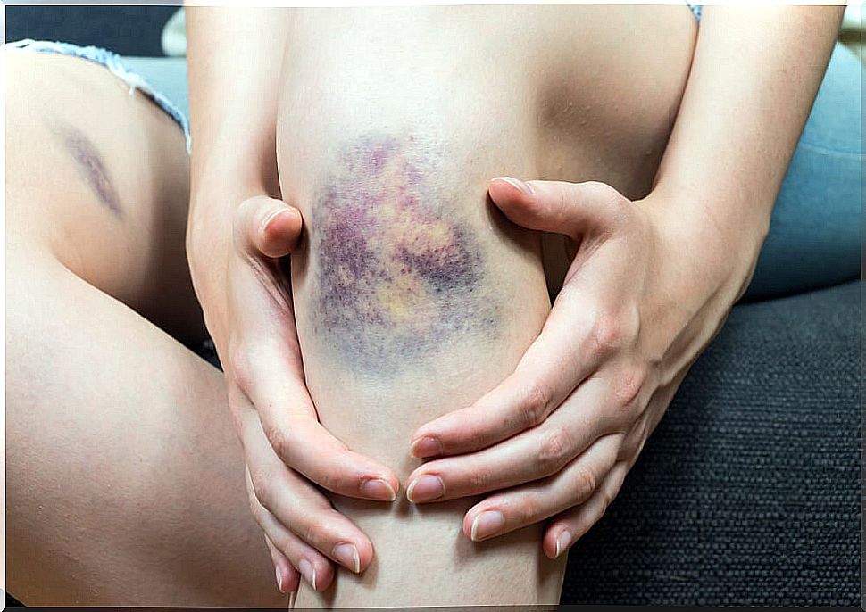 Bruises that do not heal can be one of the symptoms of cancer.