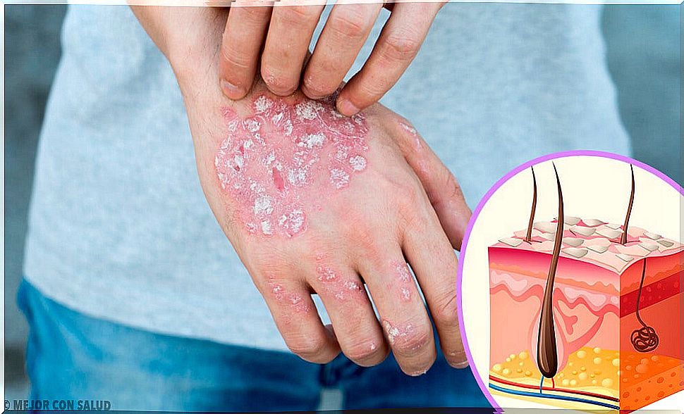 Psoriasis: causes, symptoms, diagnosis and treatment