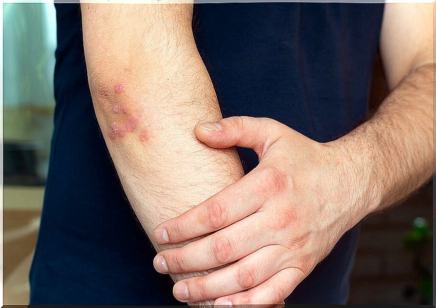 Man with psoriasis on his arm.