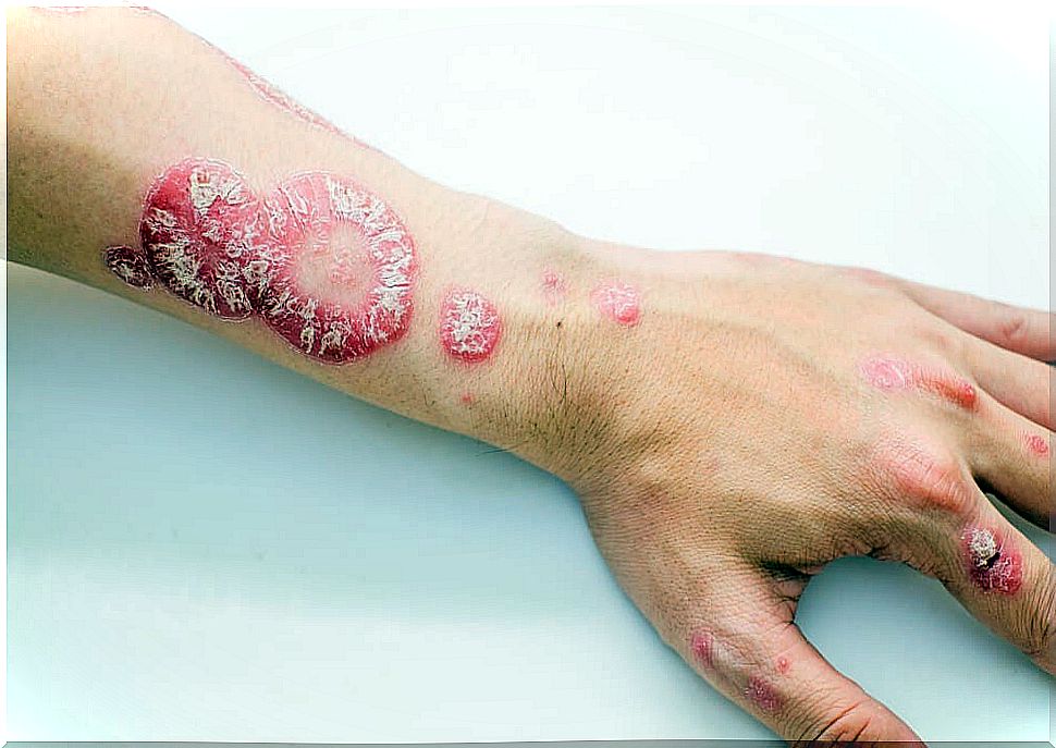 Psoriasis