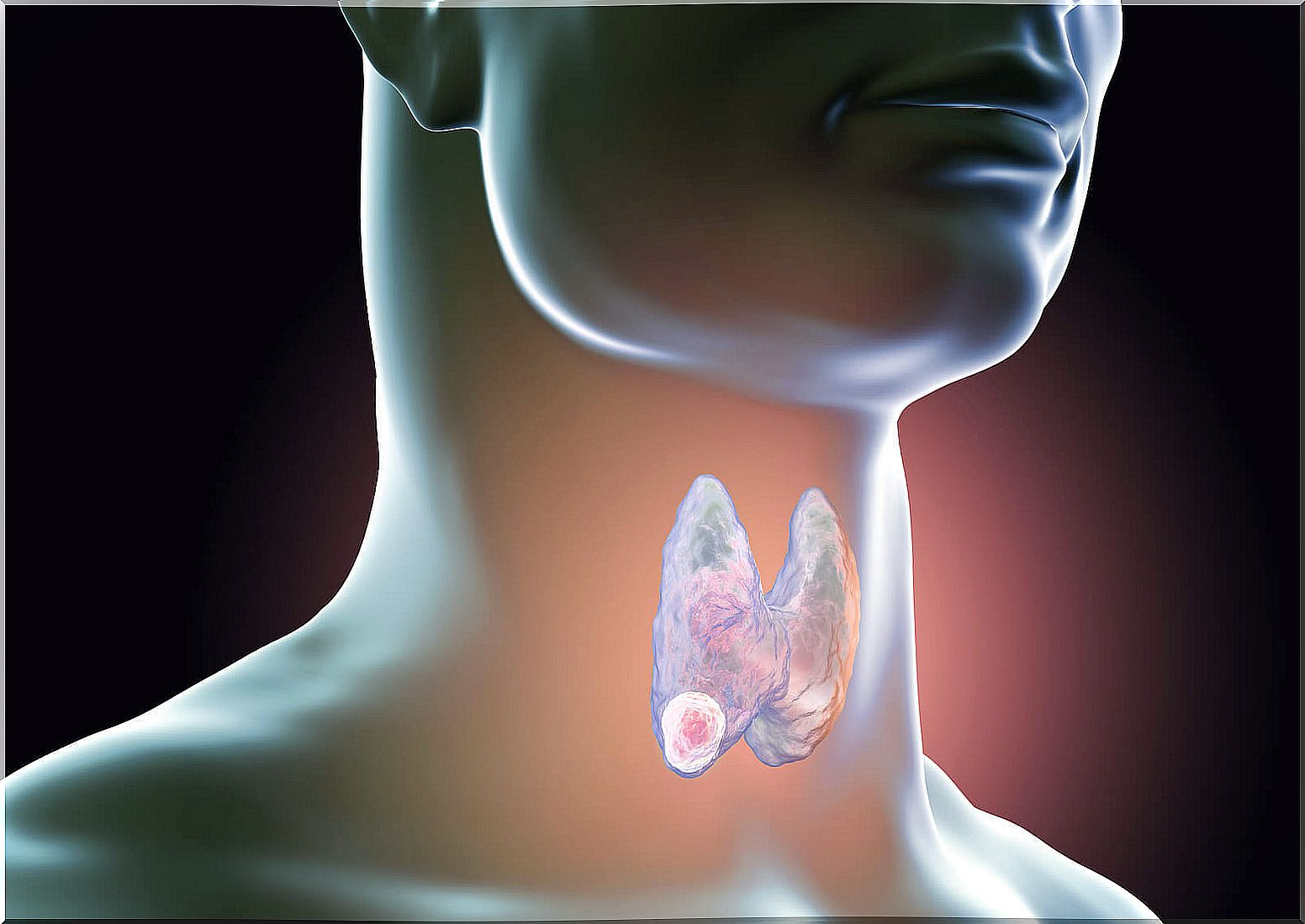 Thyroid nodule