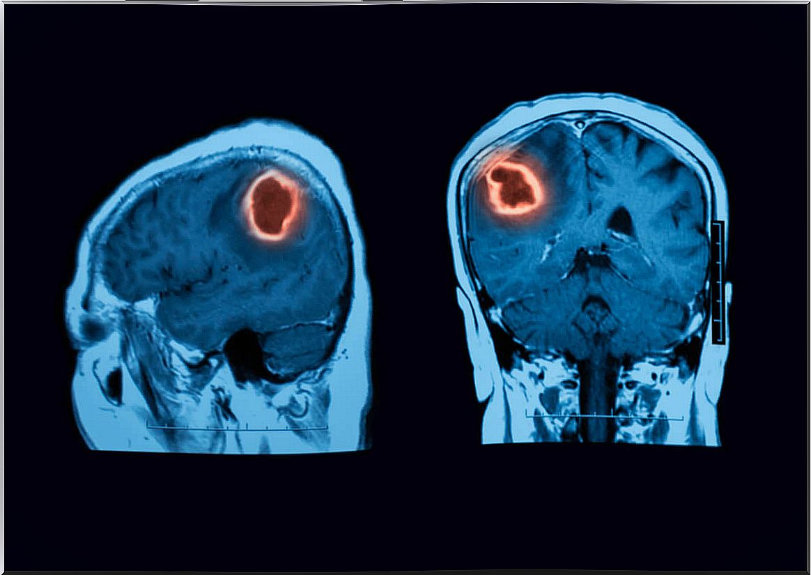 Brain MRI.