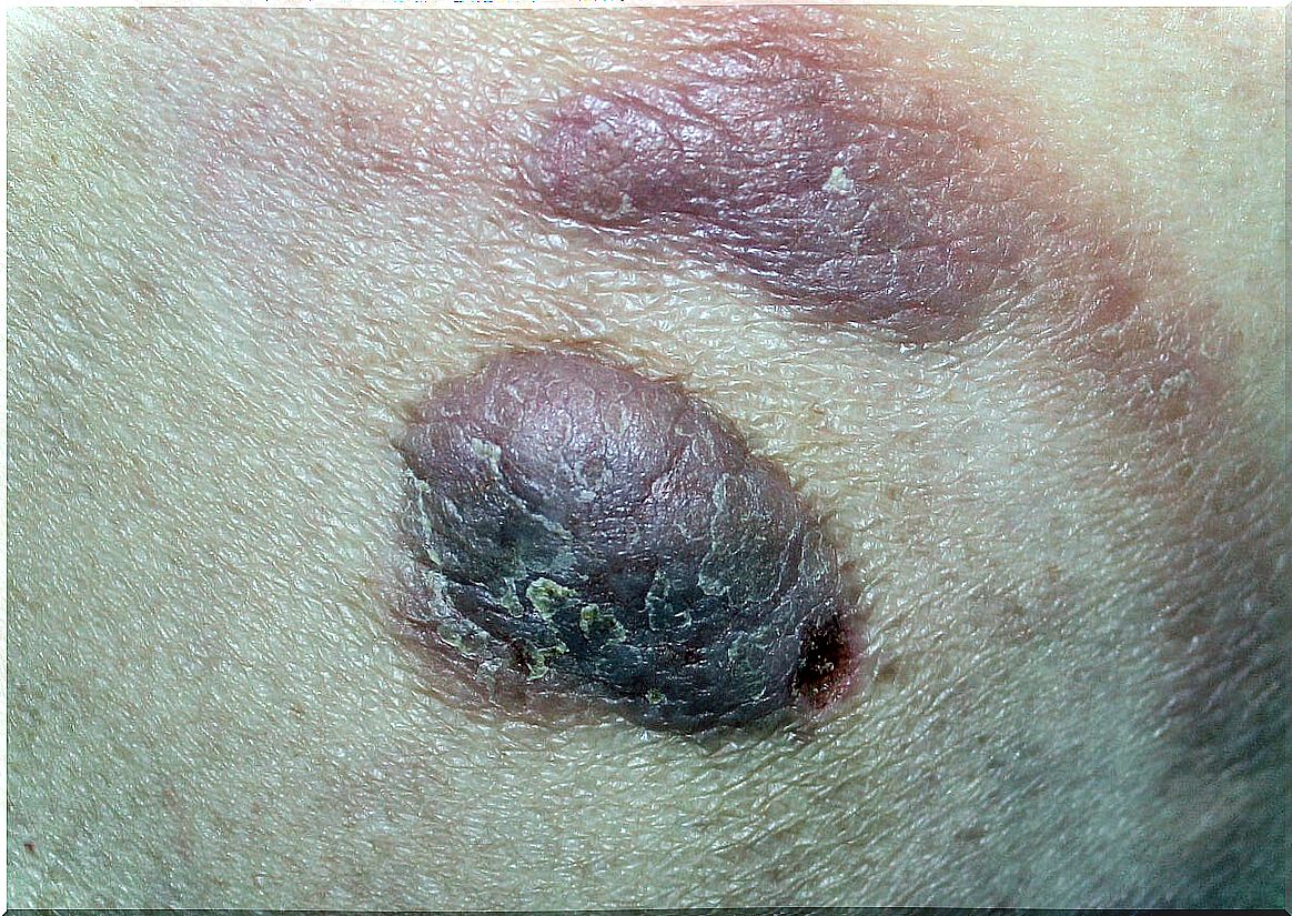 Cutaneous lymphoma lesions.